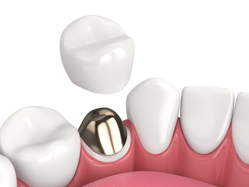 How Effective Are Dental Crowns in Restoring Tooth Function?